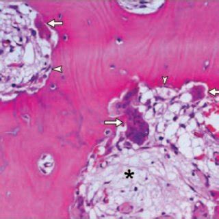 Paget Disease Lytic To Mixed Phase Photomicrograph H And E