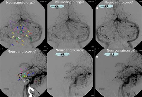 Bridging Vein (anterior brainstem group) | neuroangio.org