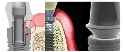 Soft Tissue Implant Integration Part 2