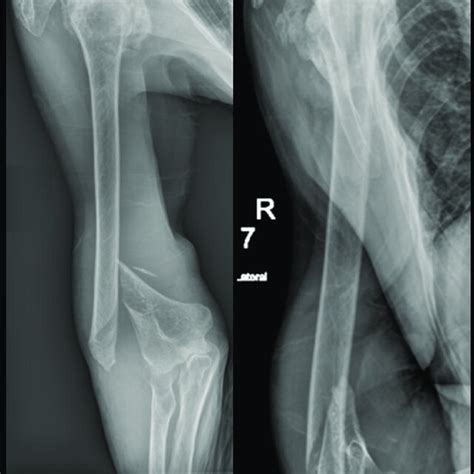 Postoperative Radiographs Showing Anterior Posterior A And Lateral