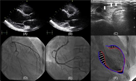 Figure 1 From A Case Of Takotsubo Cardiomyopathy In A Patient With Iatrogenic Thyrotoxicosis