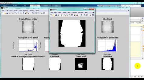 Bone Fractures Detection Using Matlab Code Top 5 Matlab Projects YouTube