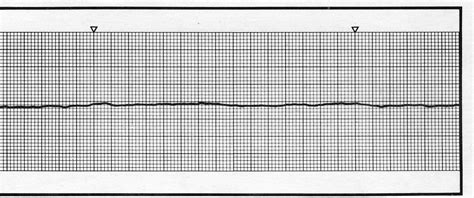 Cool Cardiology Cases!: Asystole: treat or terminate?