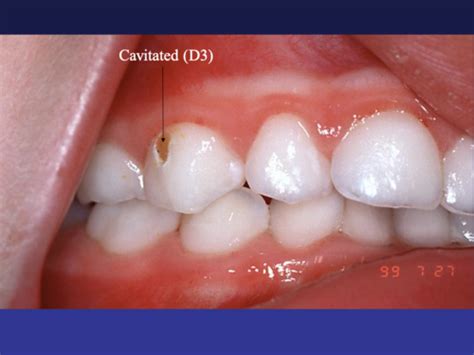 Clinical Caries Flashcards Quizlet