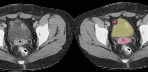 Endometriosis of the Bladder on CT scan - ART IN ANATOMY