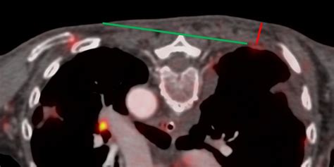 Case 143 Long Parallel Approach To Small Pleural Lesions