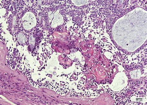 Ghost Cell Odontogenic Carcinoma Of The Jaws Report Of Two Cases And A