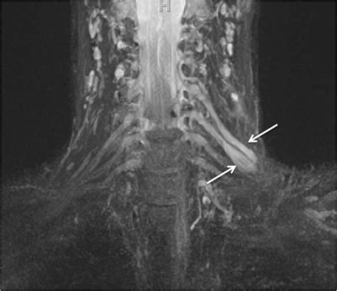 Brachial Plexus Mri