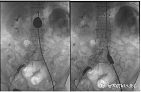 案例解析：3d打印辅助腹主动脉瘤覆膜支架腔内隔绝术 知乎