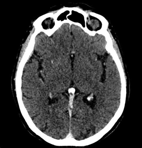 Foramen Cecum Skull