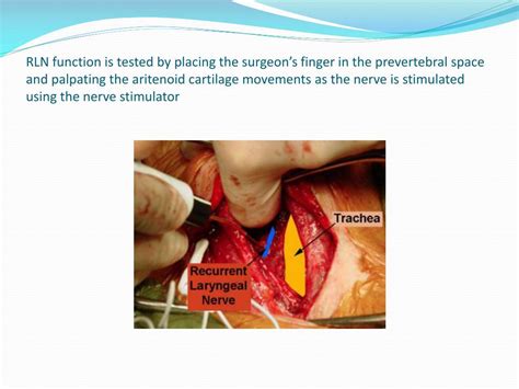 PPT - SUBTOTAL THYROIDECTOMY PowerPoint Presentation, free download ...