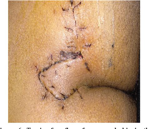 Figure 6 From Rhomboid Excision And Limberg Flap Operation For Managing