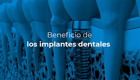 Beneficios De Los Implantes Dentales CCM Dental