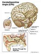 Cerebellopontine Angle CPA Medical Illustration Medivisuals