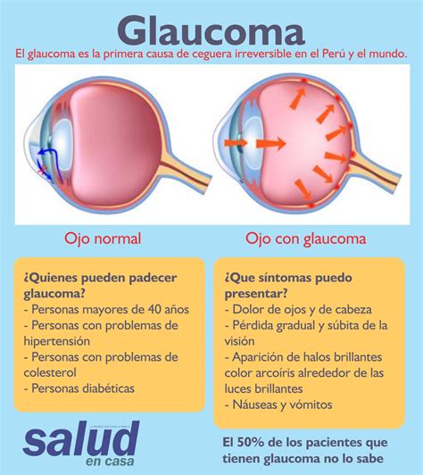 Glaucoma Una Enfermedad Silenciosa Que Causa Ceguera Irreversible