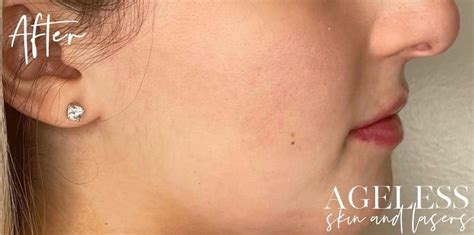 Microneedling Archives Ageless Skin And Laser Center