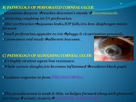 Etiology Pathology And Pathogenesis Of Corneal Ulcer