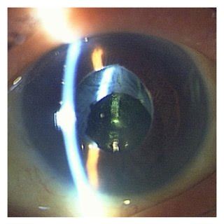 Photograph Of The Anterior Segment In The Left Eye At The First Visit