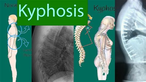 Kyphosis Slouching Posture Kyphosis Types Symptoms And Treatment