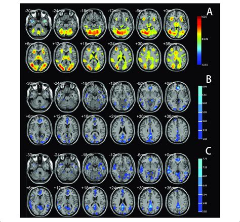 A Brain Regions Showing Significant Activation Under The Montreal