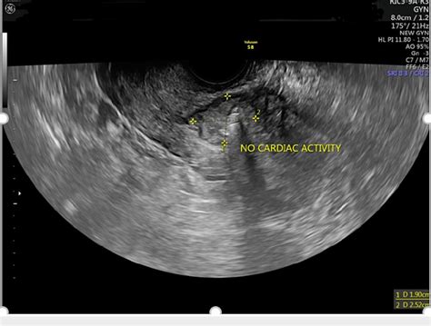 [pdf] Successful Non Surgical Management Of Cesarean Scar Pregnancy