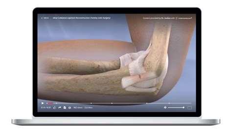 Ulnar Collateral Ligament Reconstruction Tommy John Surgery Animation