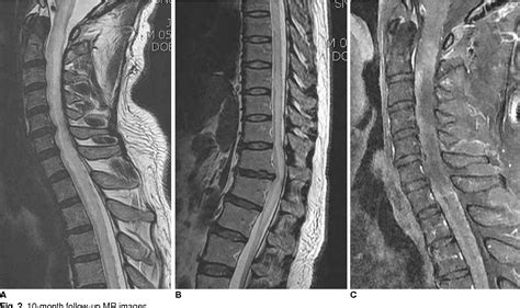 Figure From Dural Arteriovenous Fistula At The Foramen Magnum With