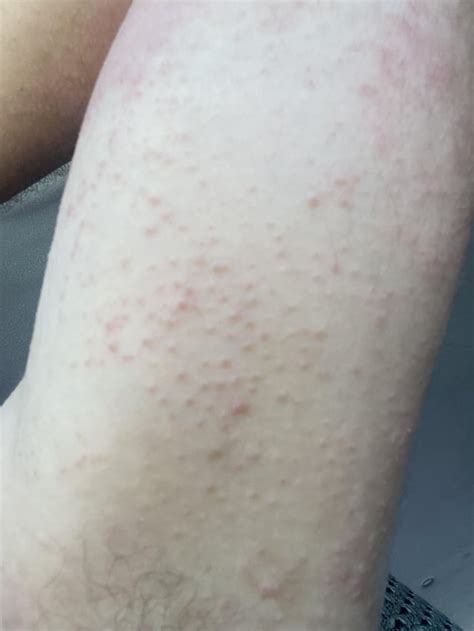 Is this a fungal induced eczema flare?? : r/Dermatology