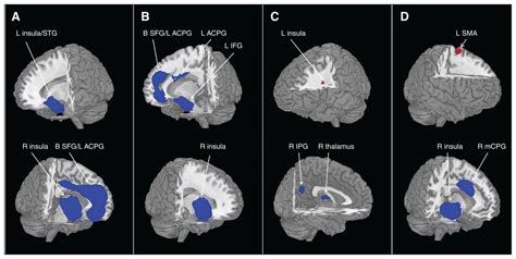 Bipolar Disorder Brain