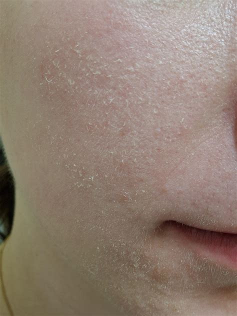 Skin peeling off : r/beauty