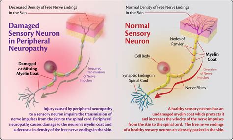 Articles Page Peripheral Neuropathy Help Center Hot Sex Picture