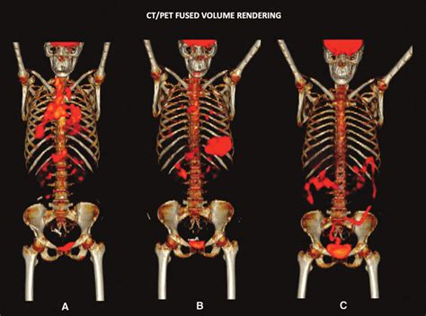 A [ 18 F]fluorodeoxyglucose Positron Emission Tomography Computed