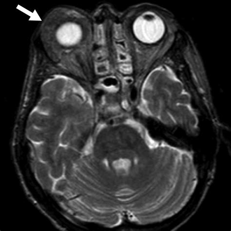 Lacrimal Gland Masses Ajr