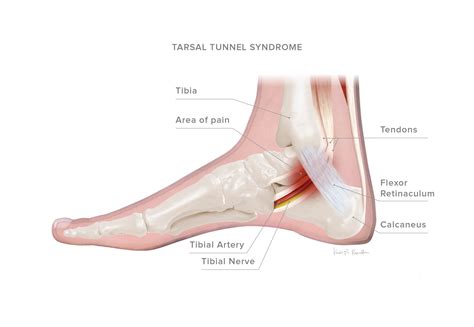 Tarsal Tunnel Syndrome – KevinRoot Medical