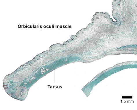 Figure 2 From Overriding Of The Preseptal Orbicularis Oculi Muscle In Caucasian Cadavers