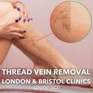 Thread Vein Treatments Now In Bristol London Vein Centre