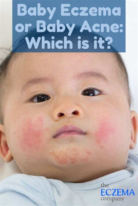 Eczema Or Baby Acne Which Is It Baby Acne Acne Baby Eczema