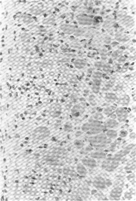 Figure 1 from The results of transvenous endomyocardial biopsy can ...