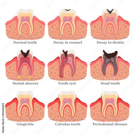 Tooth disorders set, flat vector illustration. Healthy and unhealthy teeth. Dental problems and ...