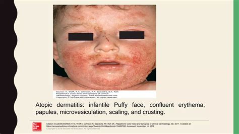 Atopic Dermatitis Ppt