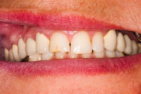 Enamel Hypoplasia (Chalky Teeth) Causes and Treatment | Savina Clinics