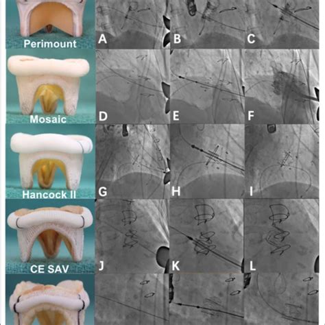 Valve In Valve Implantation Of A J Valve Into Different Degenerated