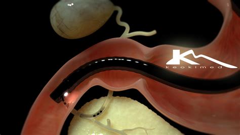 Ercp Endoscopic Retrograde Cholangio Pancreatography Keokimed