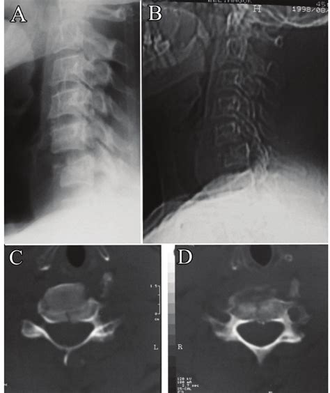 A And B The Preoperative Plain Lateral Radiograph Cervical Spine