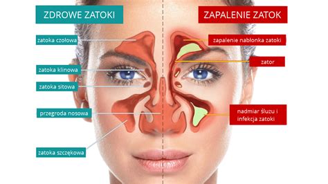 Zatoki I Zapalenie Zatok Objawy Leczenie Profilaktyka Naturalnie