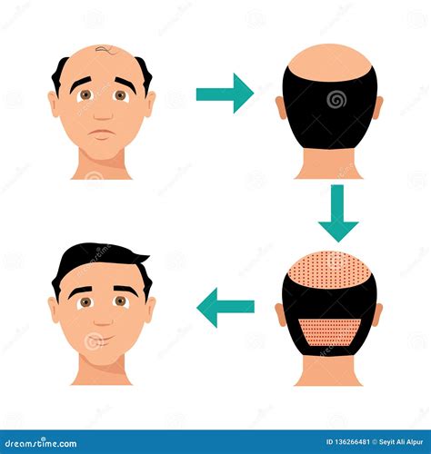 Hair Transplantation Stock Illustration Illustration Of Head 136266481