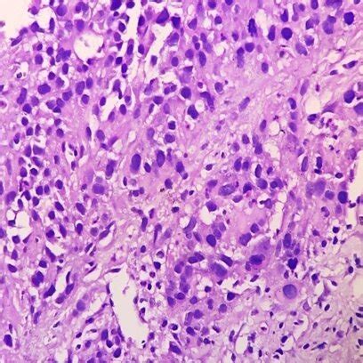 Photomicrograph Showing Hepatocellular Carcinoma H E 40X