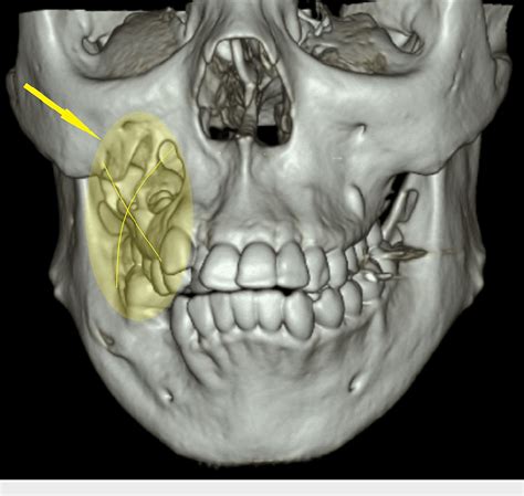 Figure 1 From Understanding Nevoid Basal Cell Carcinoma Syndrome