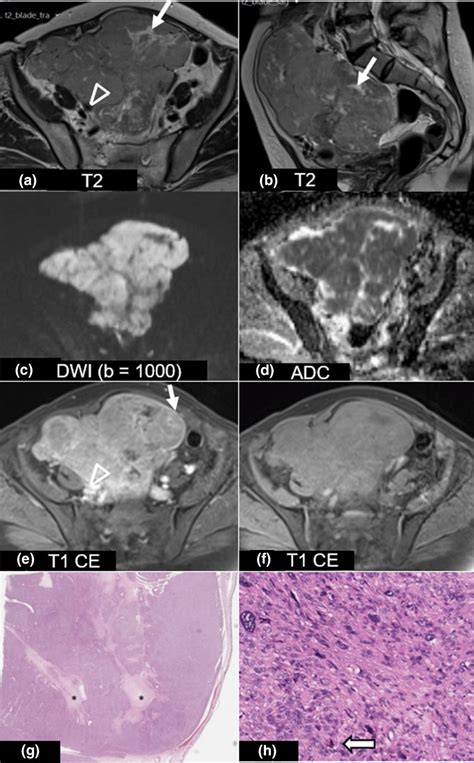 Leiomyosarcoma In A 71 Year Old Woman Axial A And Sagittal B T2wi