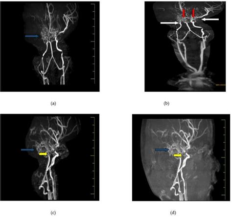 Magnetic Resonance Cerebral Angiography A B Bilateral Narrowing Of